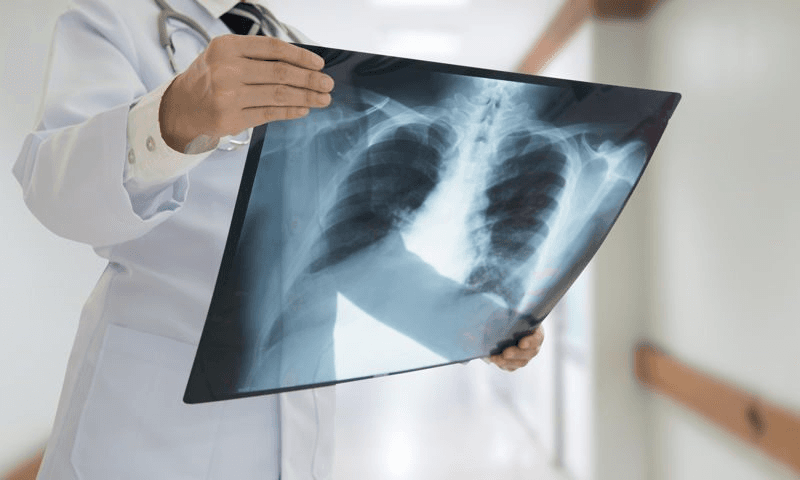 Tuberculosis: advierten sobre el aumento de casos en Gualeguaychú al igual que en el resto del país - imagen de origen